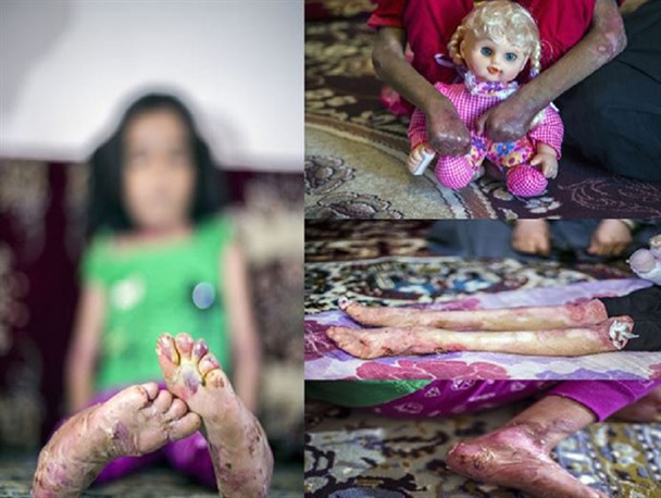 مرگ خاموش کودکان جنوب کرمان/تصاویر ۱۸+